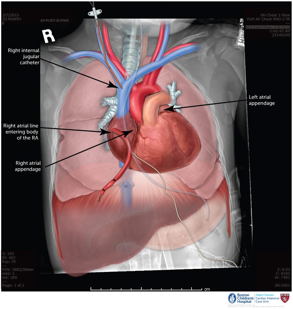 Interpreting a CXR – Online supplement