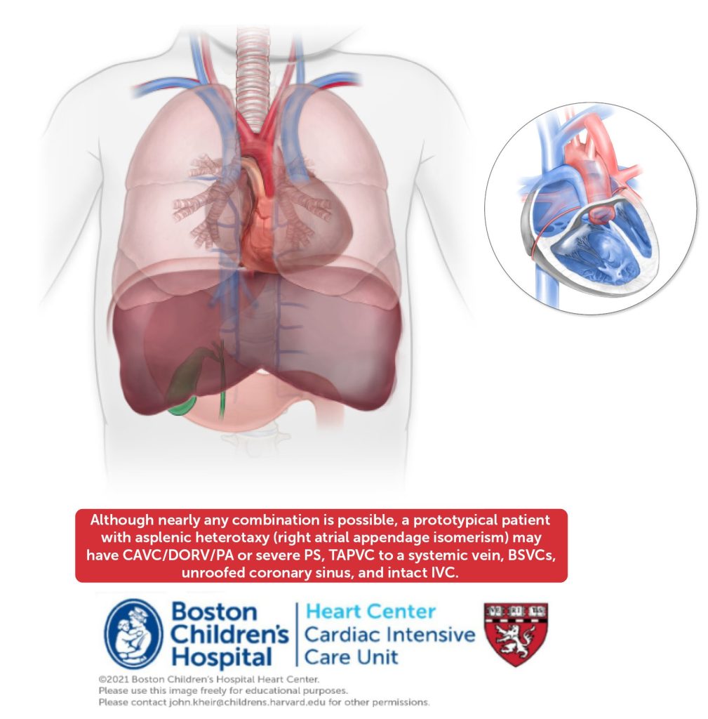 Right Atrial Isomerism asplenia Online Supplement Right atrial isomerism asplenia online supplement
